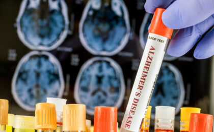 Mini-cervelli sviluppati per la ricerca sull'Alzheimer