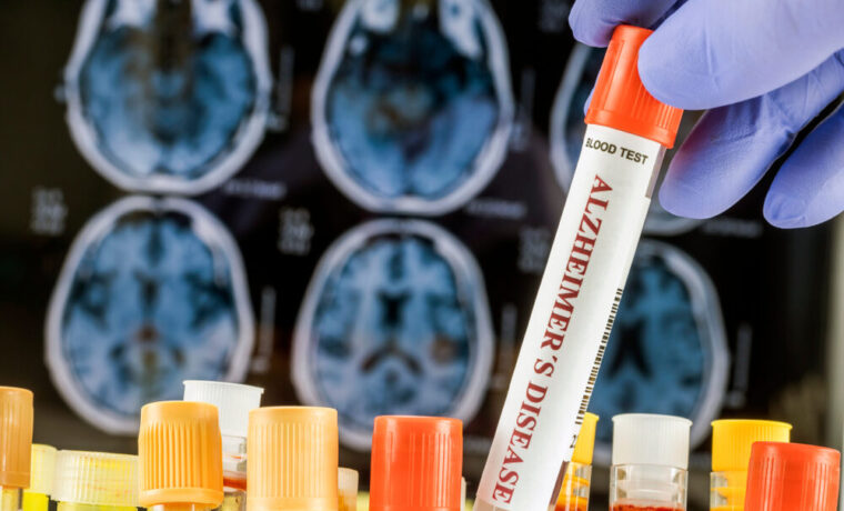 Mini-cervelli sviluppati per la ricerca sull'Alzheimer