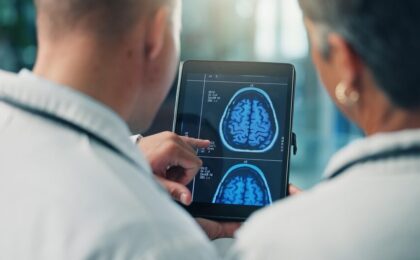 Immagine di un elettrocardiogramma che rappresenta la fibrillazione atriale